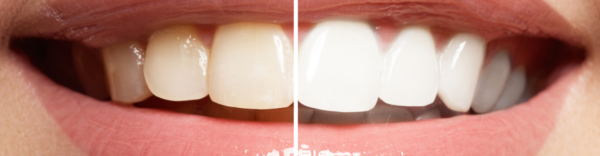 Smile with half of the teeth whiter than the other half