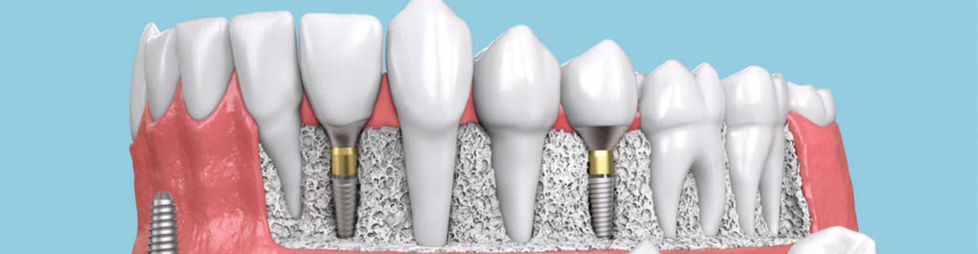 teeth with implants in the gums