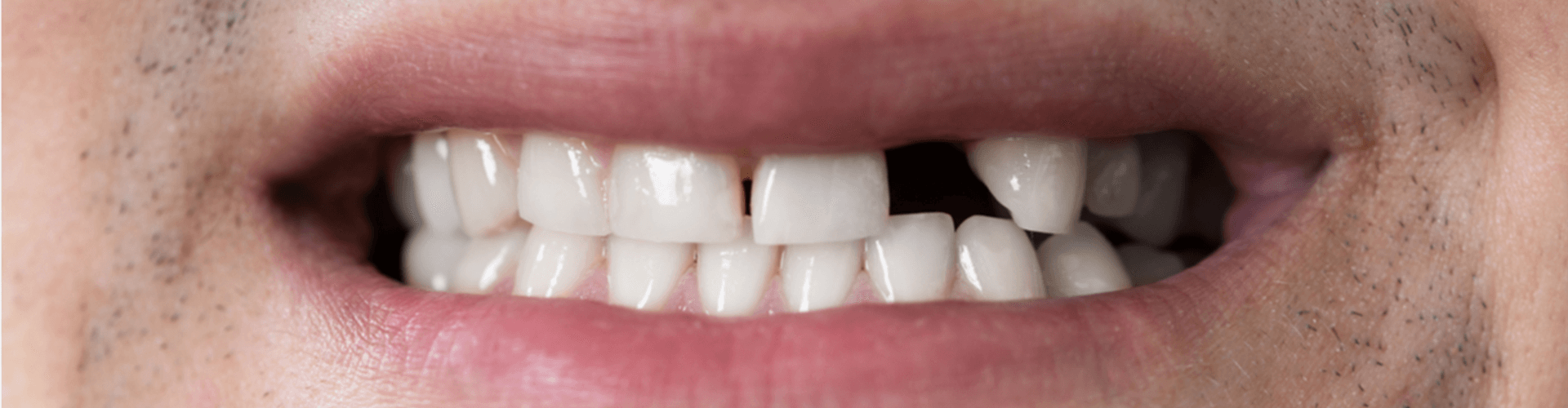 Smile with missing tooth 