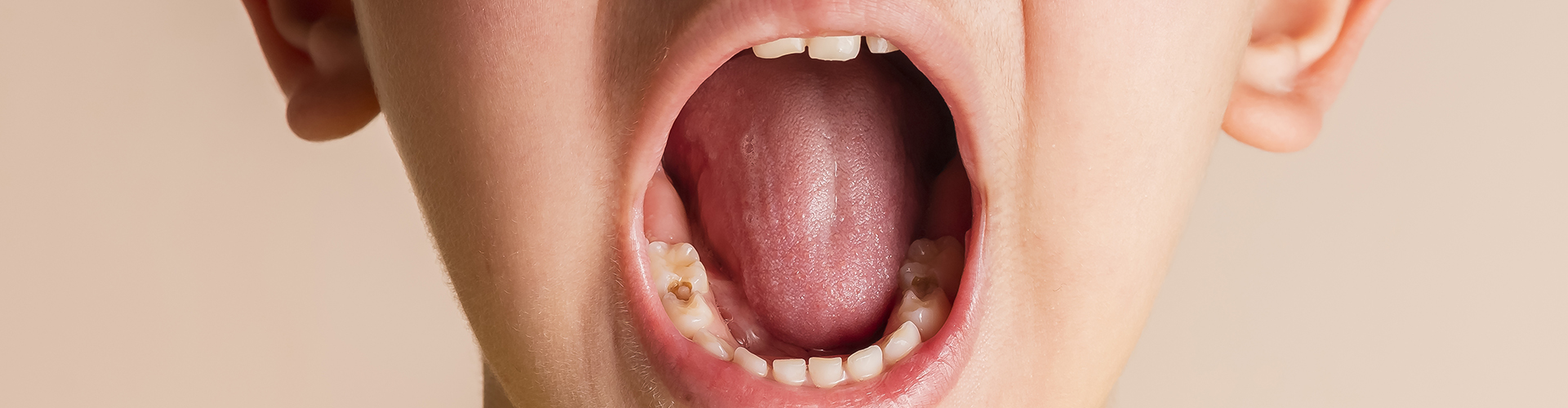 child opening mouth wide showing cavity in tooth