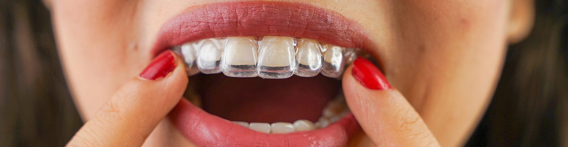woman placing aligner on her teeth