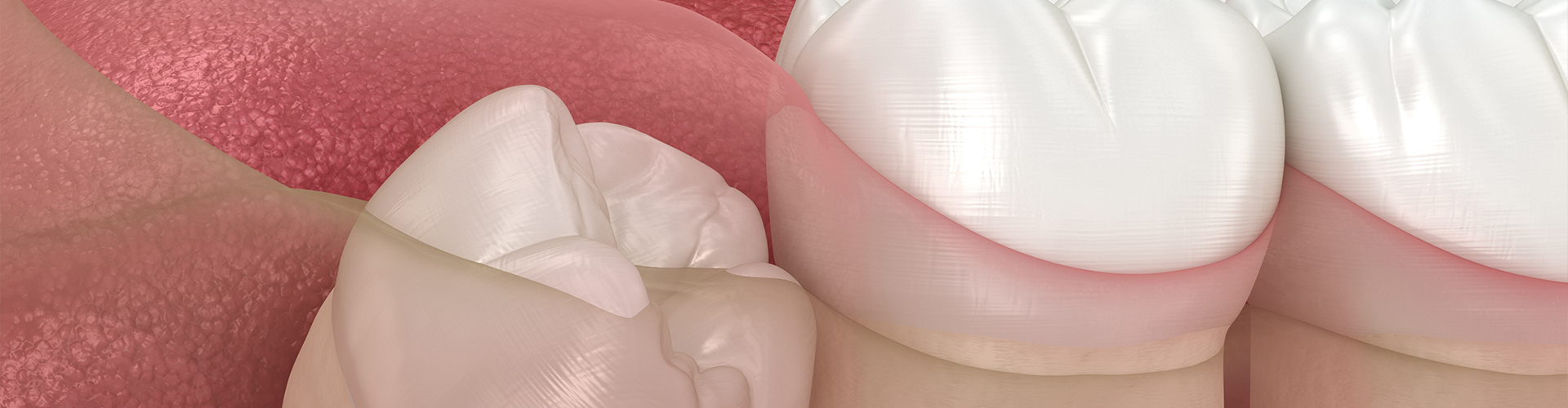 rendering of a wisdom tooth partially under the gum
