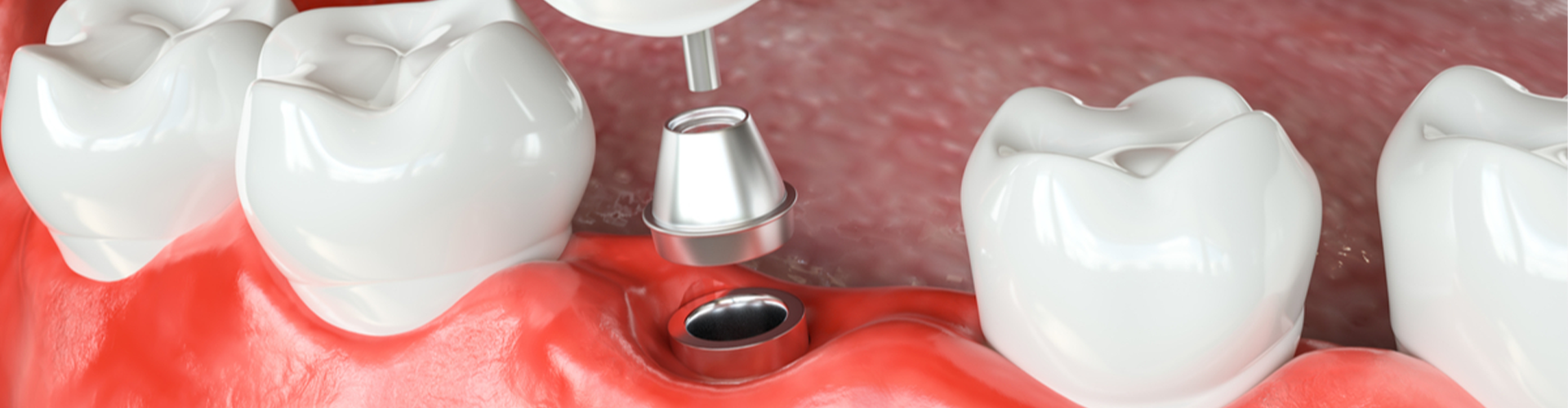 Mouth with screw and tooth 