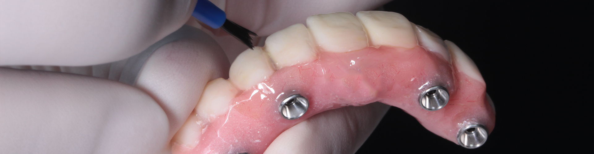 hand holding upper implant-retained denture