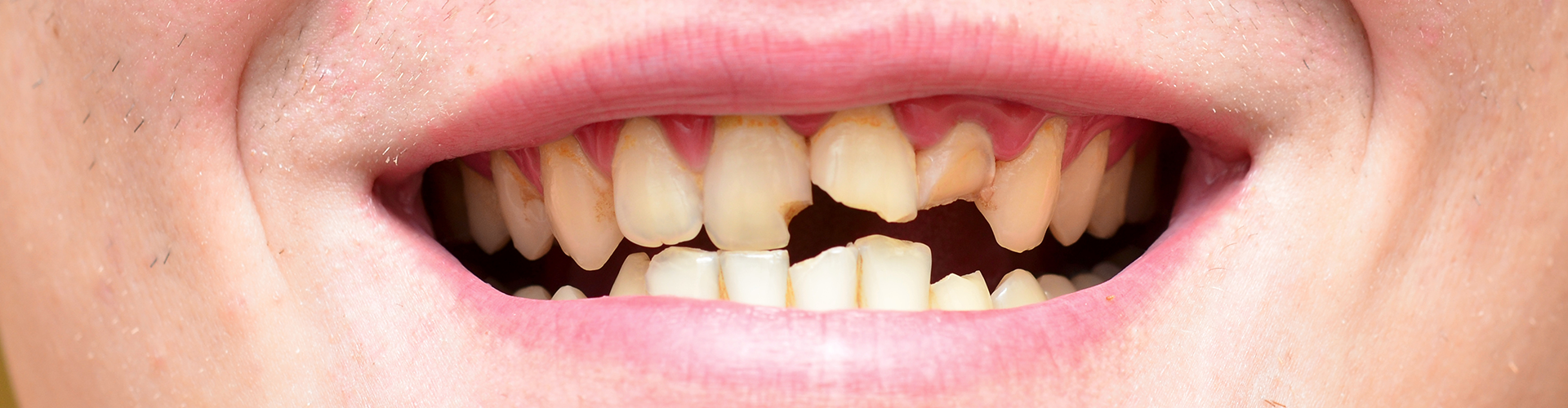 close-up of a smile showing multiple broken teeth