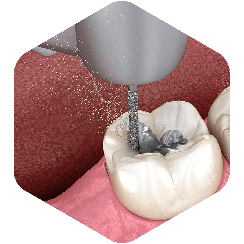 A 3D illustration of pulp removal teeth.