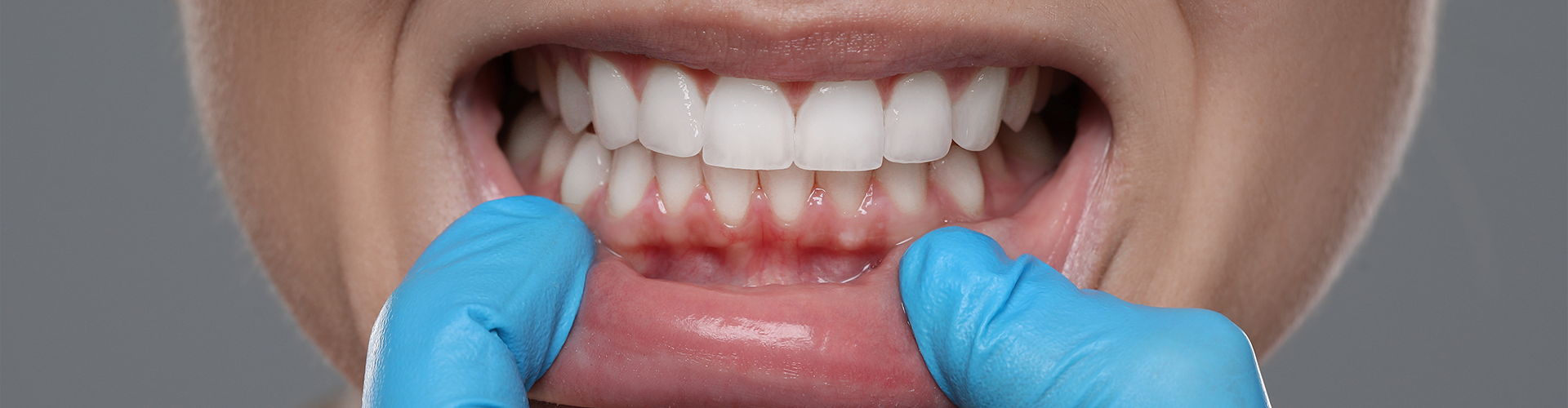 gloved hand lowering a woman's lip to show inflamed gums