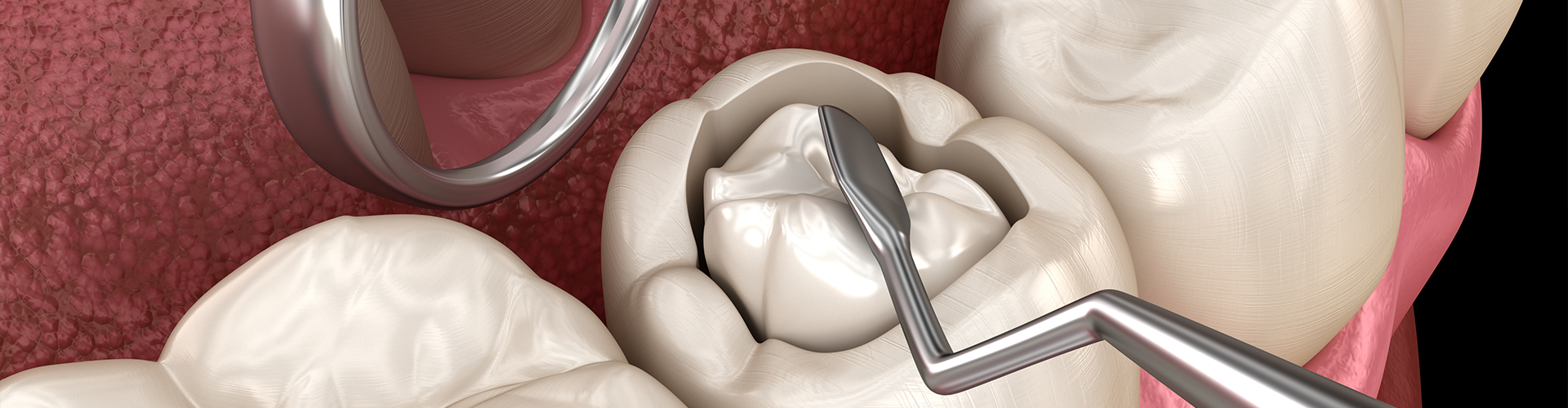 rendering of silver cavity filling