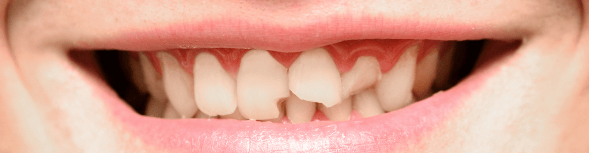 Smile with a chipped tooth