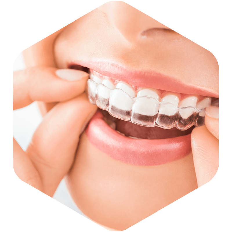 Patient showing her aligners