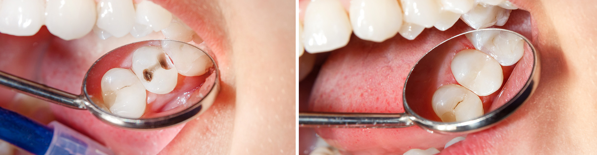 dental mirror showing tooth decay in teeth