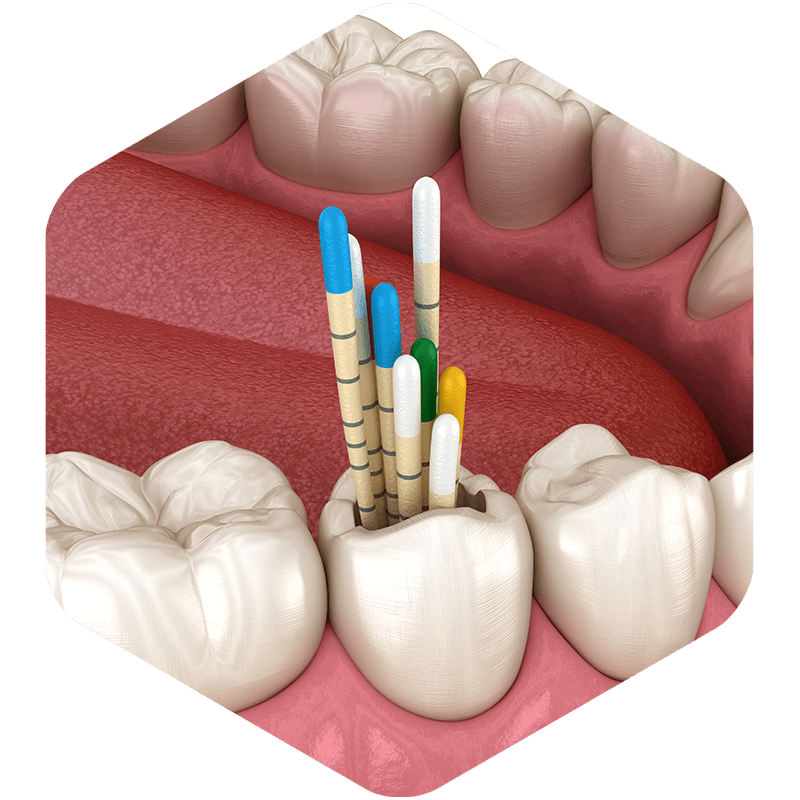 A 3D illustration of gutta-percha on teeth.