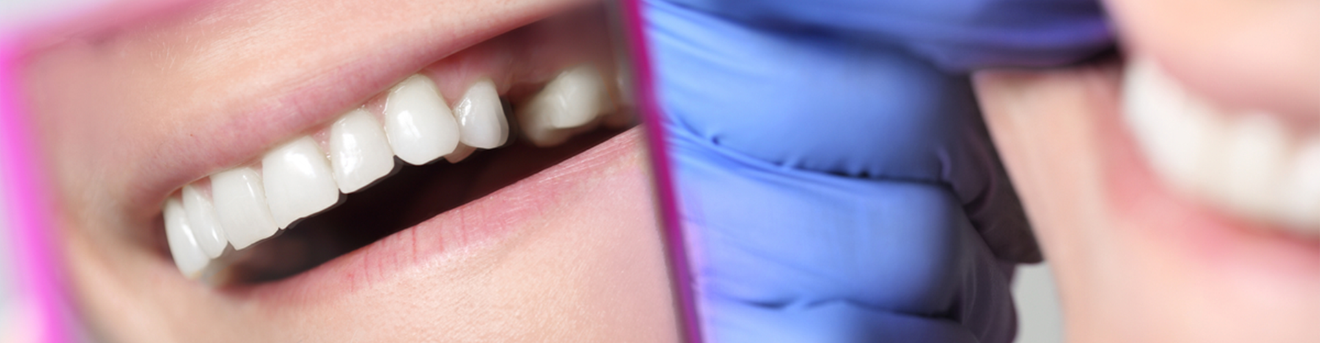 Mirror of smile with missing tooth 