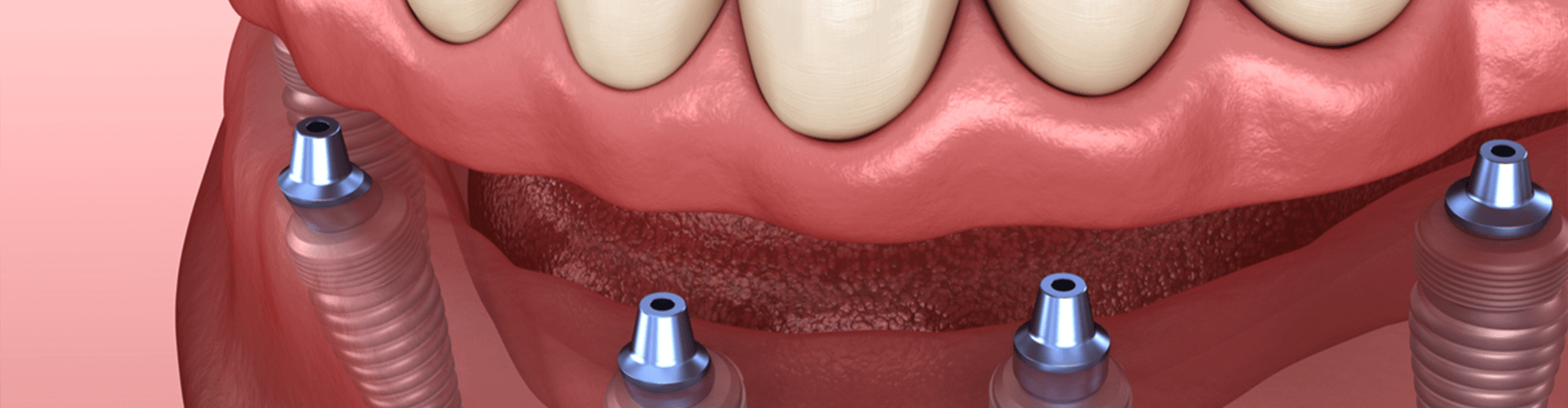 Dental implants 