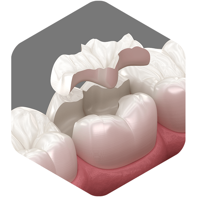 3D illustration showing a dental filling in a tooth.