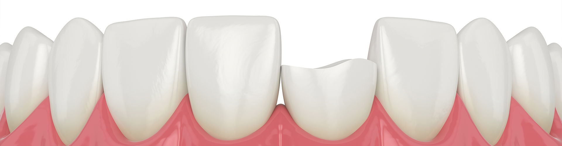 rendering of teeth with one chipped