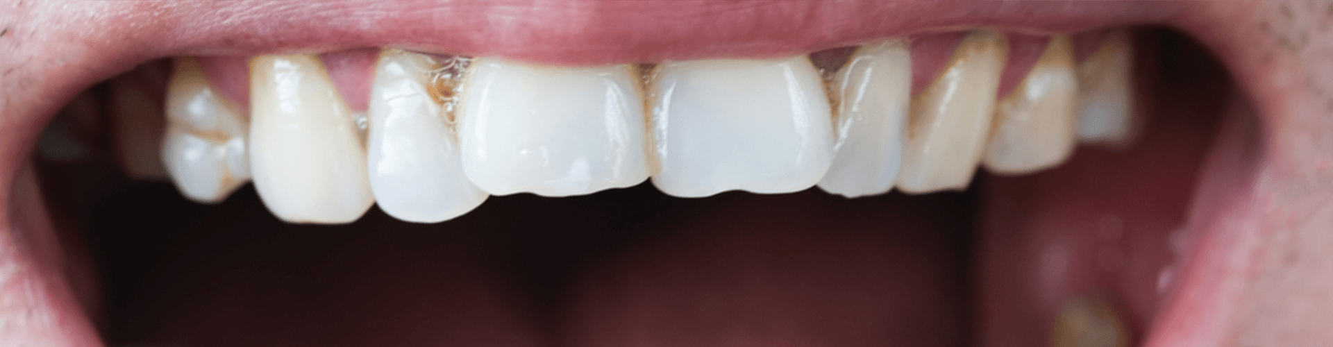 Teeth decaying.