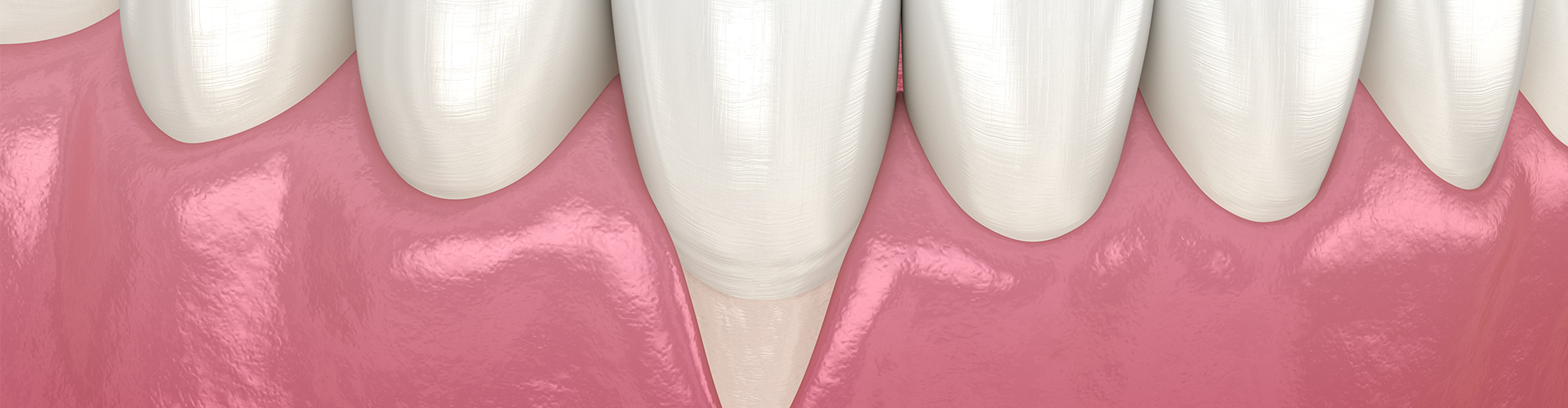 rendering of teeth with gum recession