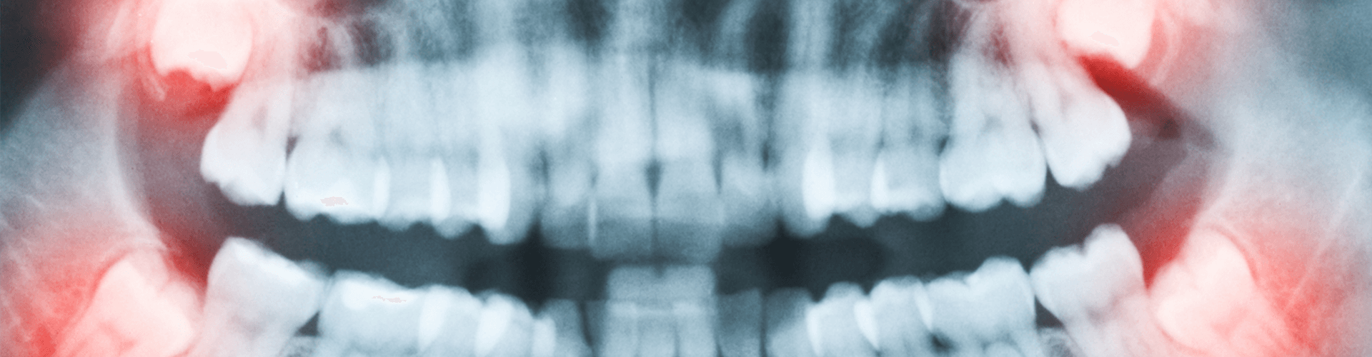 Teeth x-ray.