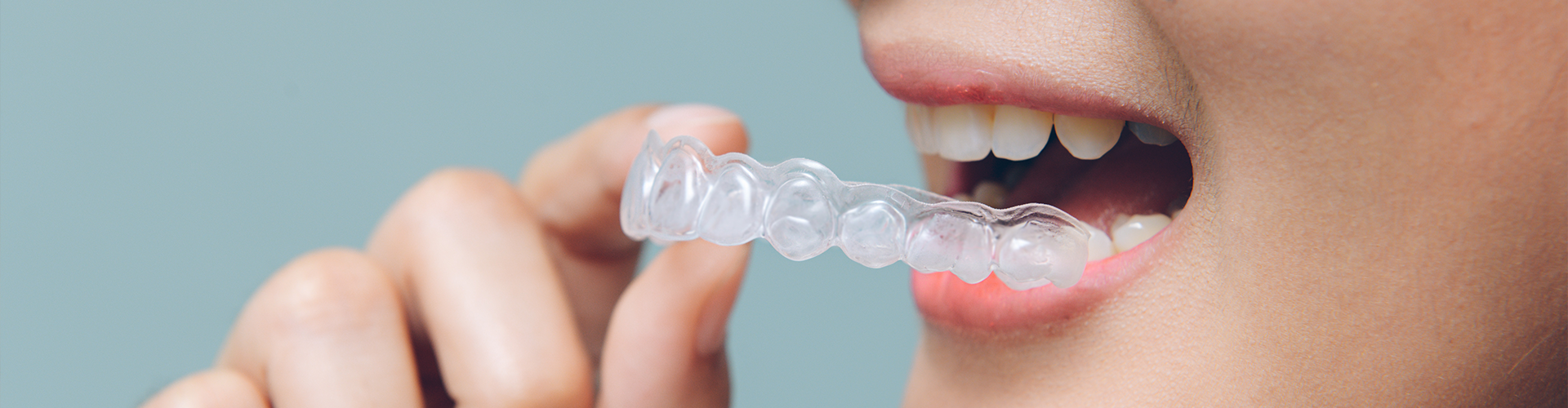 woman placing clear aligner in her mouth