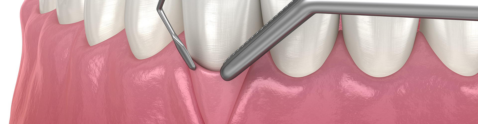 rendering of dental tools placing a gum graft