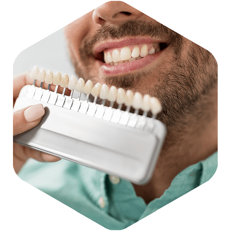 Man smiling with veneers displayed in front of his teeth.