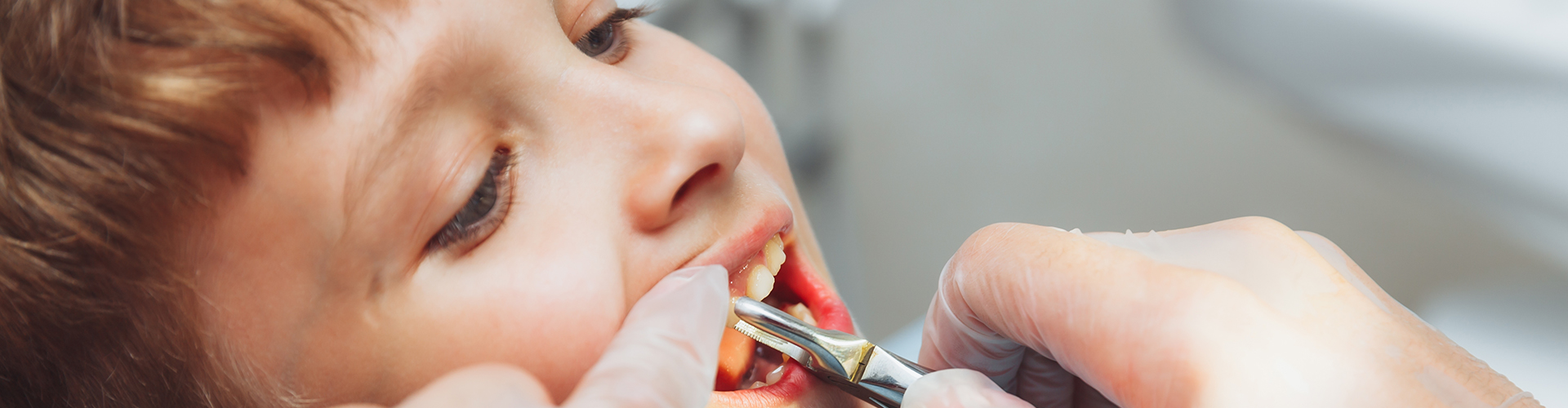 childs mouth with pliers pulling a tooth