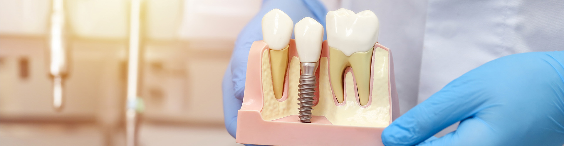 model of a dental implant between two teeth