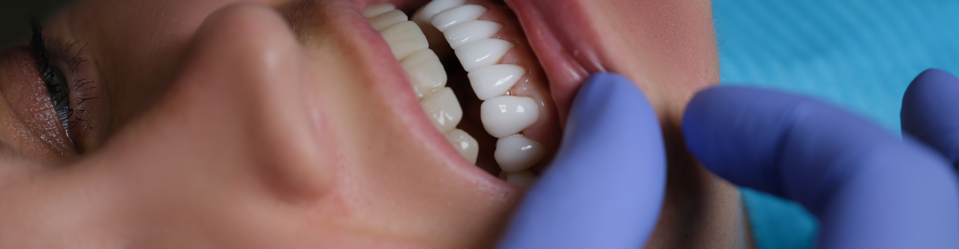 gloved hands holding down lower lip of patient to reveal teeth