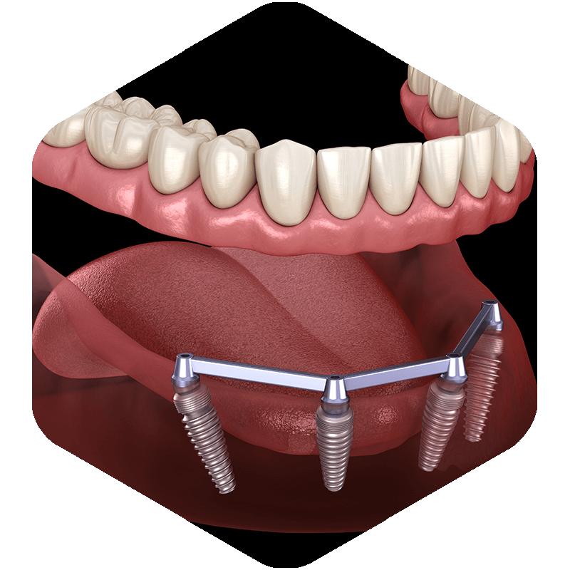 3D illustration of implant-supported dentures.