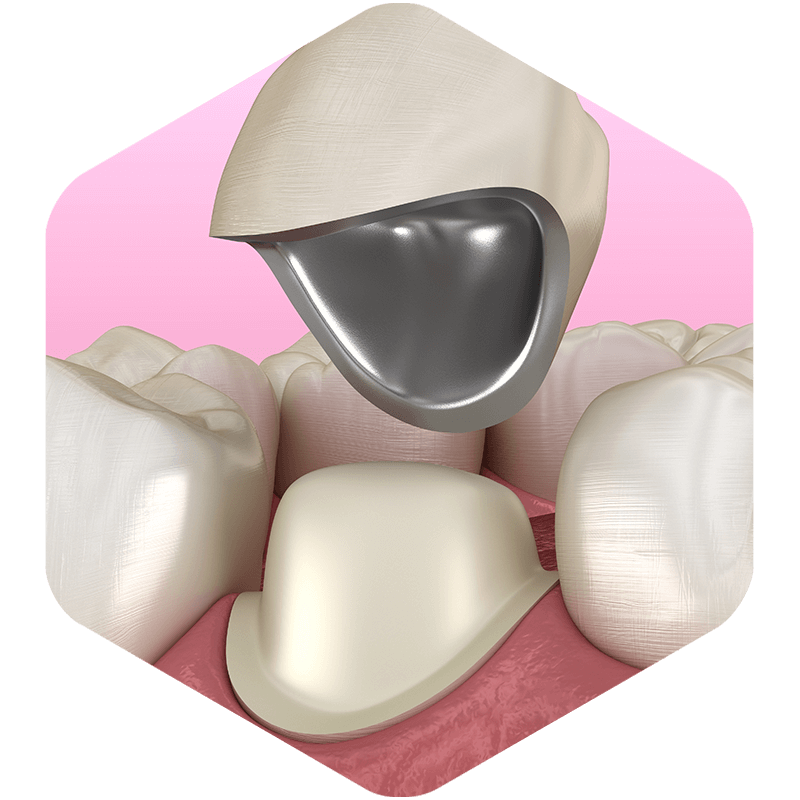 A 3D illustration of a crown being placed.
