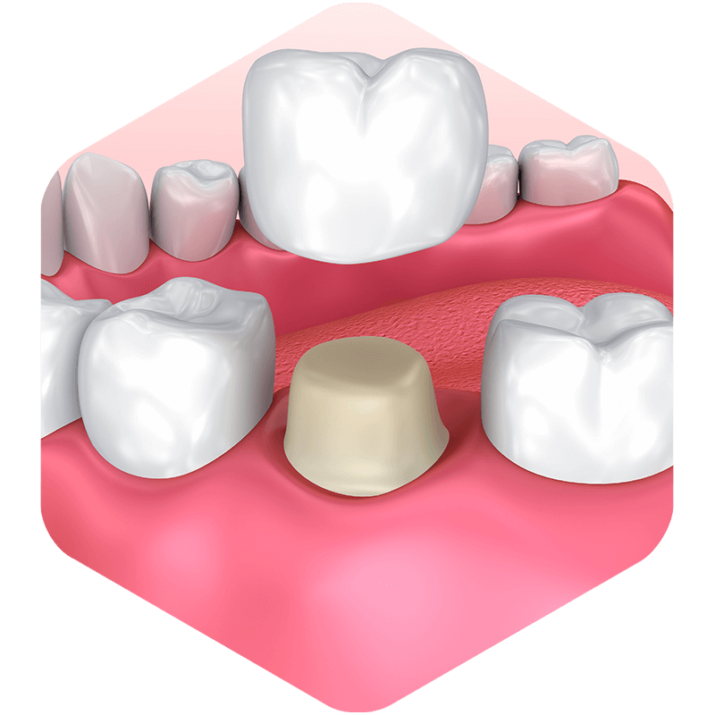 A 3D dental crown being placed.