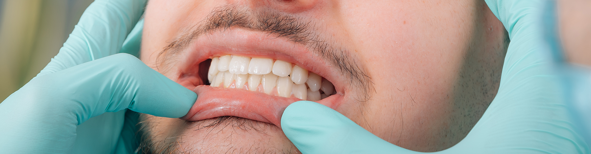 gloved hands pulling down man's lip to show gums