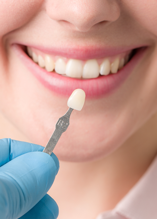 Dental veneer held in front of a patient's smile.