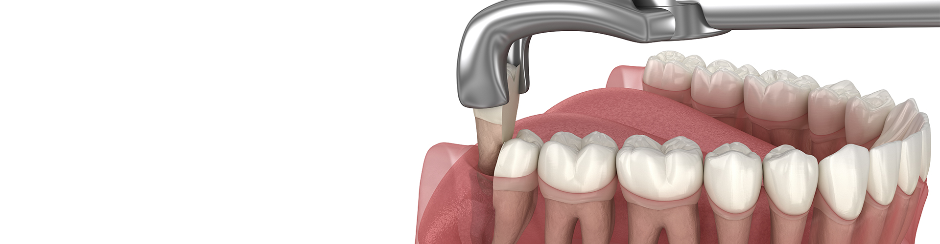rendering of a lower jaw with a wisdom tooth being removed