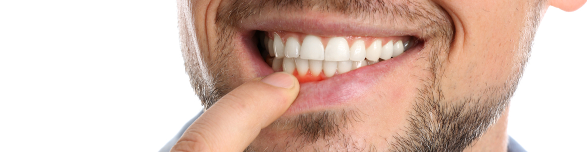 picture of a man pointing to his gums 