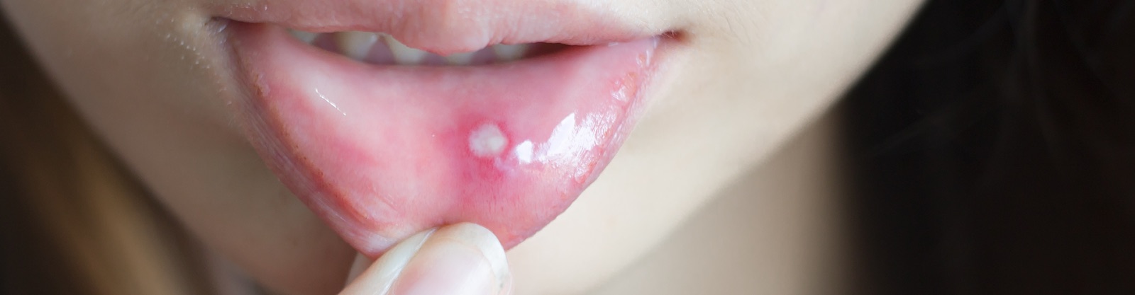 woman pulling down lower lip to show canker sore