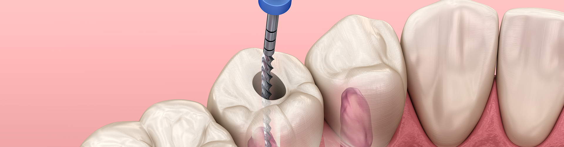 rendering of root canal treatment on a tooth