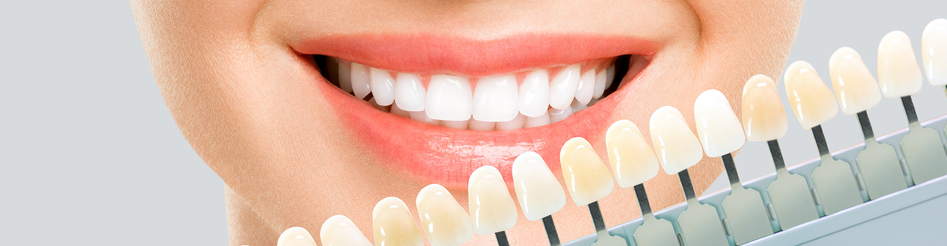teeth shade scale in front of woman's milsing mouth