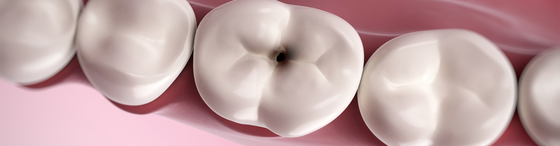 Tooth with a hole in it 