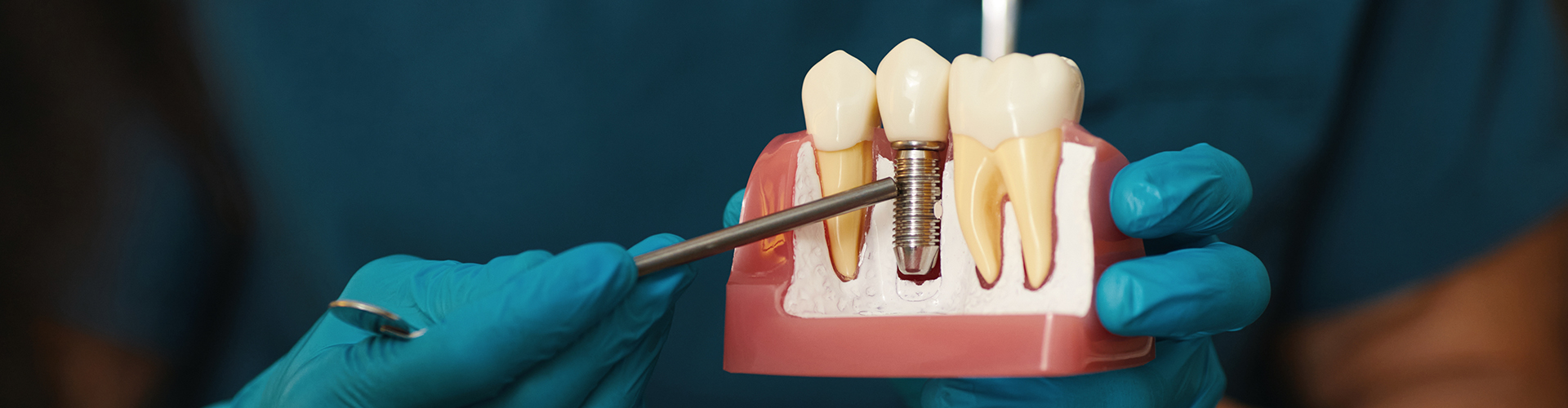 gloved hands holding dental implant model