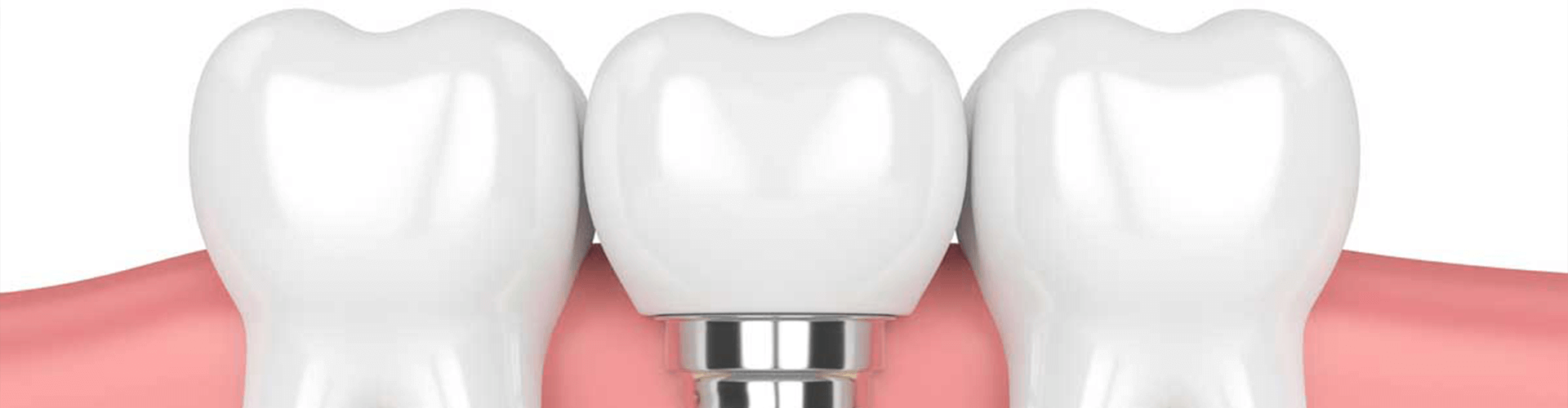 Implant with drill in the gums.