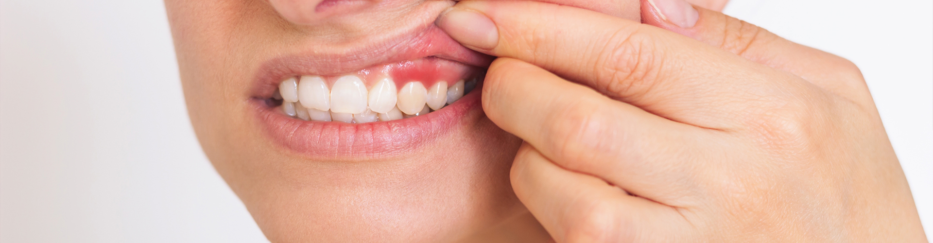 woman lifting lip to reveal inflamed gum