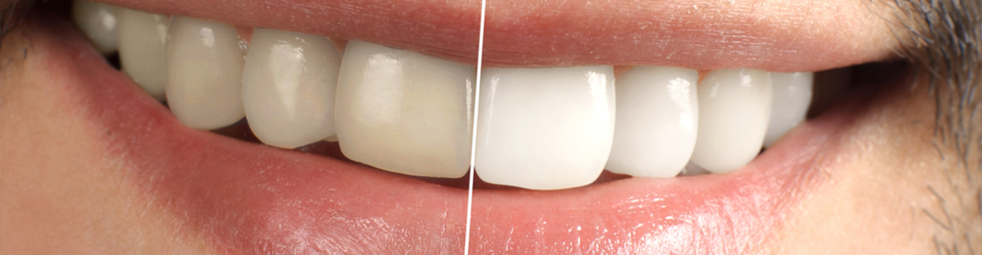 smile with a line down the center half white half yellow