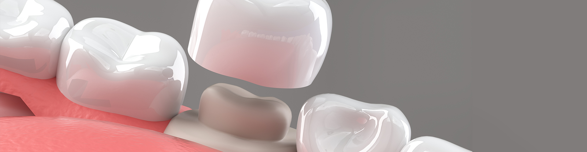 mouth model of a crown being placed on a tooth