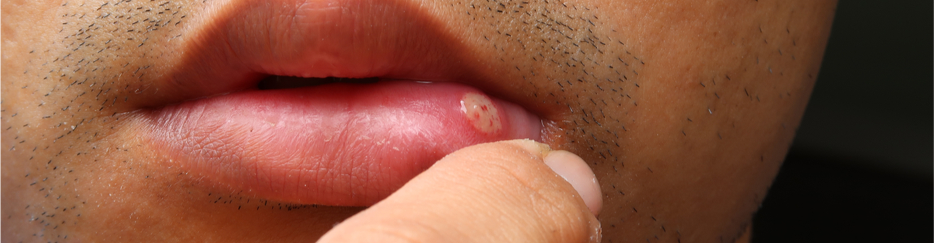 Lip with canker sore 