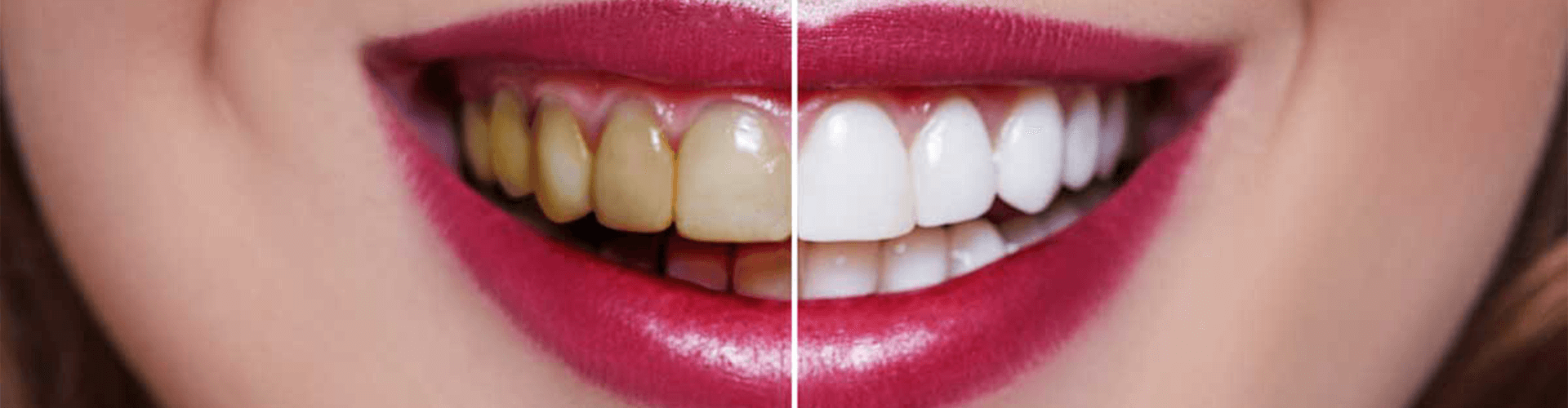 Before and after veneers.