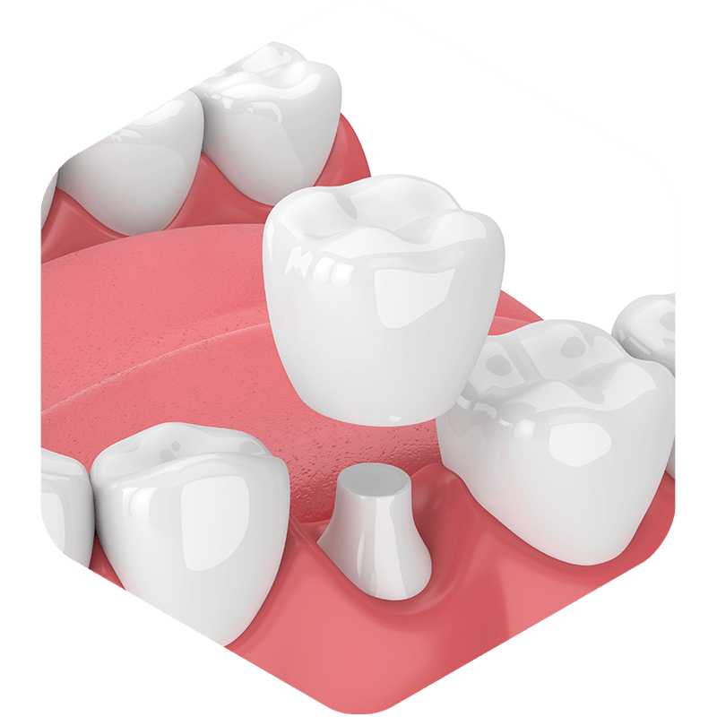 3D illustration of a crown being placed.