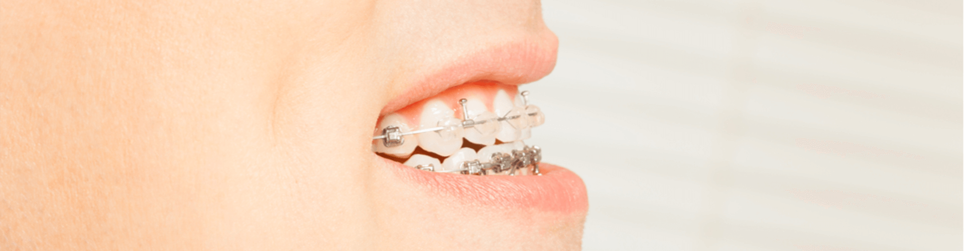 a smile with braces