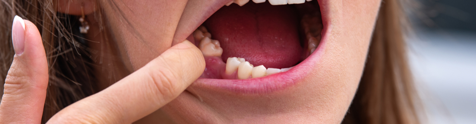 woman revealing tooth gap